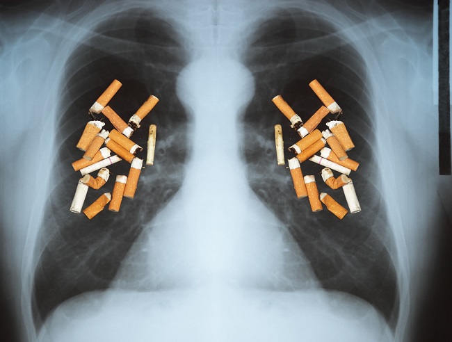 Quería donar sus pulmones, pero estaban negros tras fumar durante 30 años