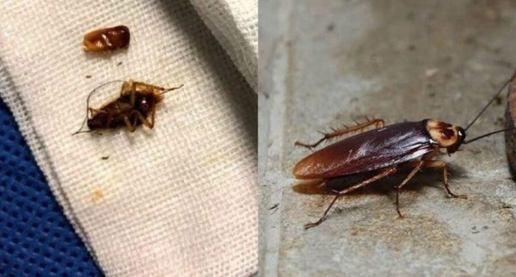 Hombre va al médico por un dolor de cabeza y le sacan una docena de cucaracha del oído