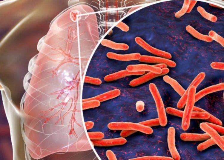 ¿Por qué es tan peligrosa la tuberculosis?