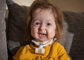 Niña de 2 años parece una anciana por «enfermedad de Benjamin Button»