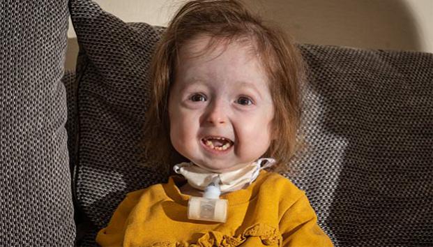 Niña de 2 años parece una anciana por «enfermedad de Benjamin Button»