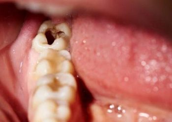 Advierten que las caries podrían causar tu muerte