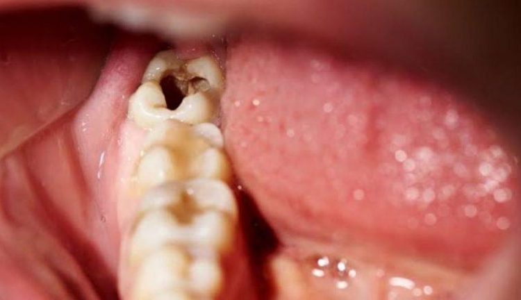 Advierten que las caries podrían causar tu muerte
